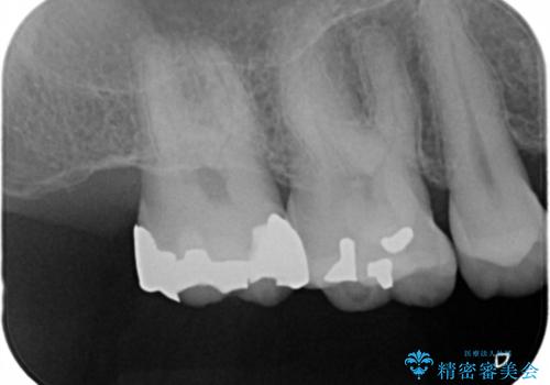 昔治療した銀歯を綺麗なセラミックに変えたい セラミックインレーの治療前