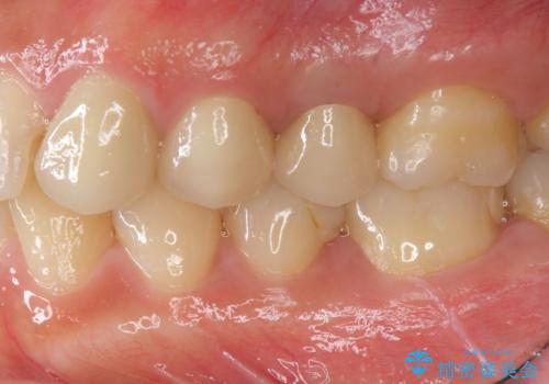挺出小矯正を行った縁下カリエス治療の治療後