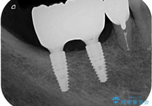 骨の造成を同時に行うインプラント治療の治療後