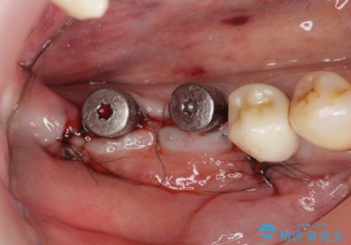 骨の造成を同時に行うインプラント治療の治療中