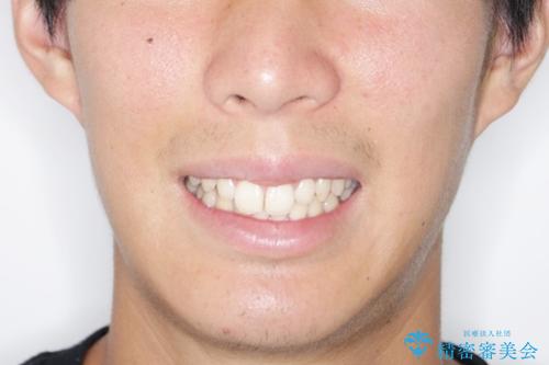 前歯が見えすぎる:インビザラインFULLで奥歯の噛み合わせも改善の治療前（顔貌）
