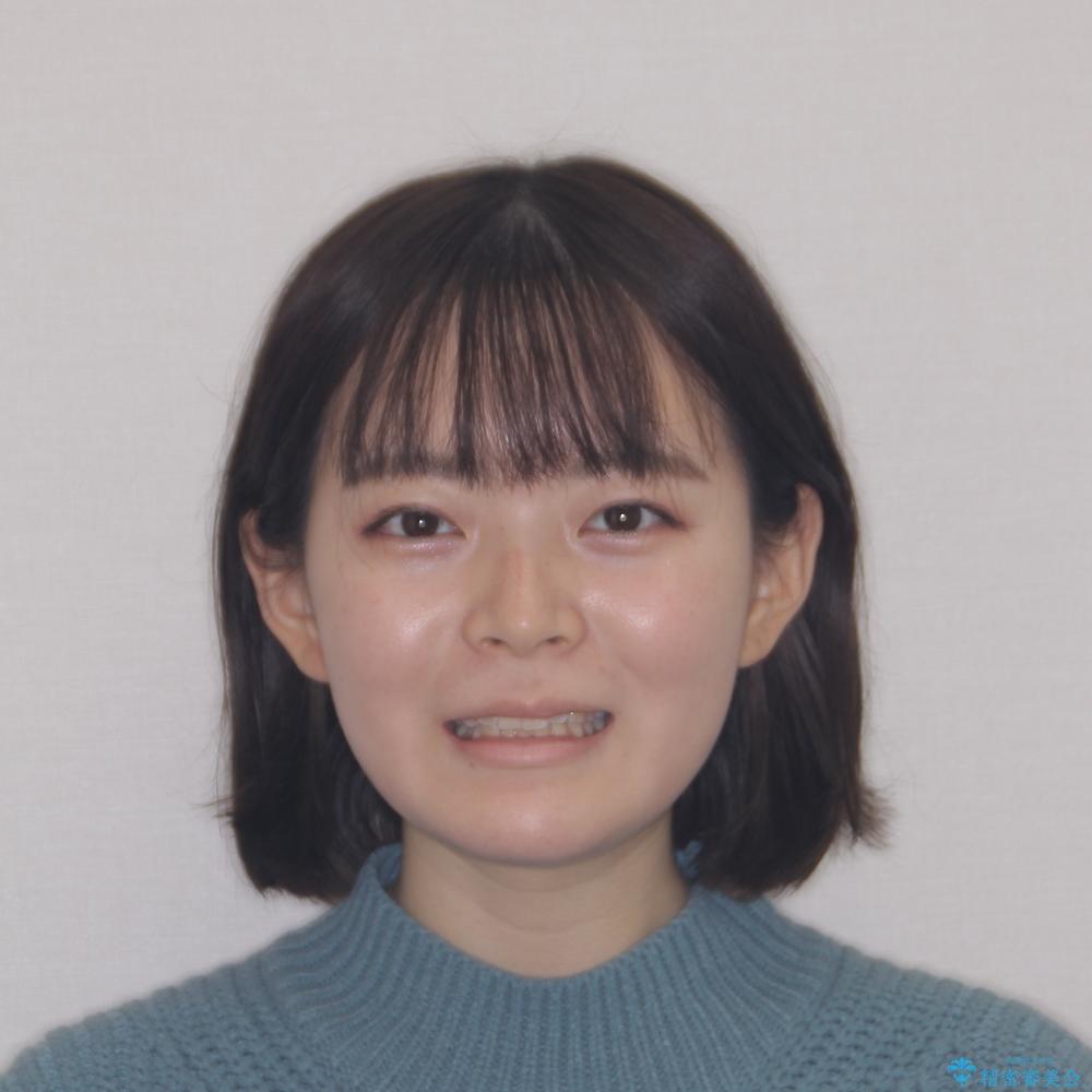 【モニター】前歯のデコボコを目立たないワイヤー装置で短期間矯正治療の治療前(顔貌)