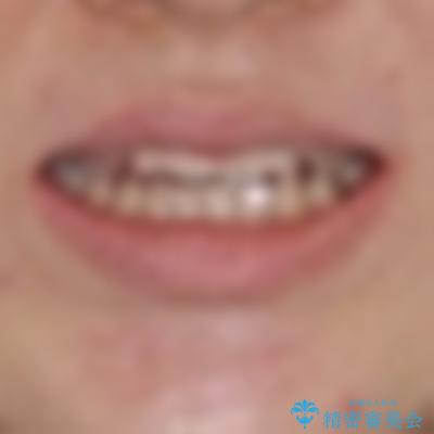 オープンバイトと前歯のデコボコをインビザライン矯正で解消の治療前(顔貌)