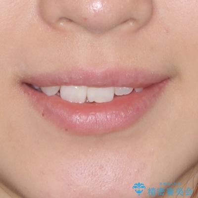 インビザラインが続けられない ワイヤー矯正での抜歯矯正 その2の治療前(顔貌)