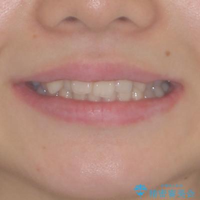 上顎のみの抜歯矯正　前歯のデコボコを改善するの治療前（顔貌）