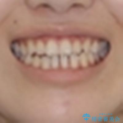 舌突出癖で口元が開いてしまう 舌トレーニングを行ったインビザライン矯正の治療前(顔貌)