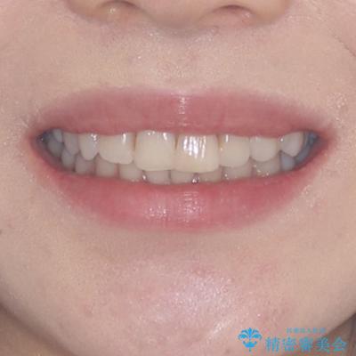 前歯の突出感とデコボコをインビザライン矯正で改善の治療前（顔貌）