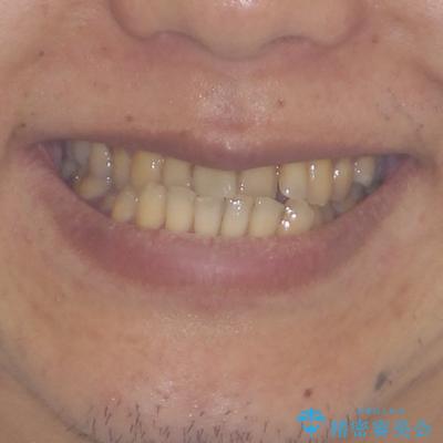 前歯のクロスバイトを改善　ワイヤー装置での非抜歯矯正の治療前（顔貌）