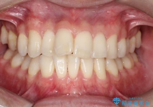 前歯の重なりとガタガタをマウスピースで改善した症例の症例 治療前