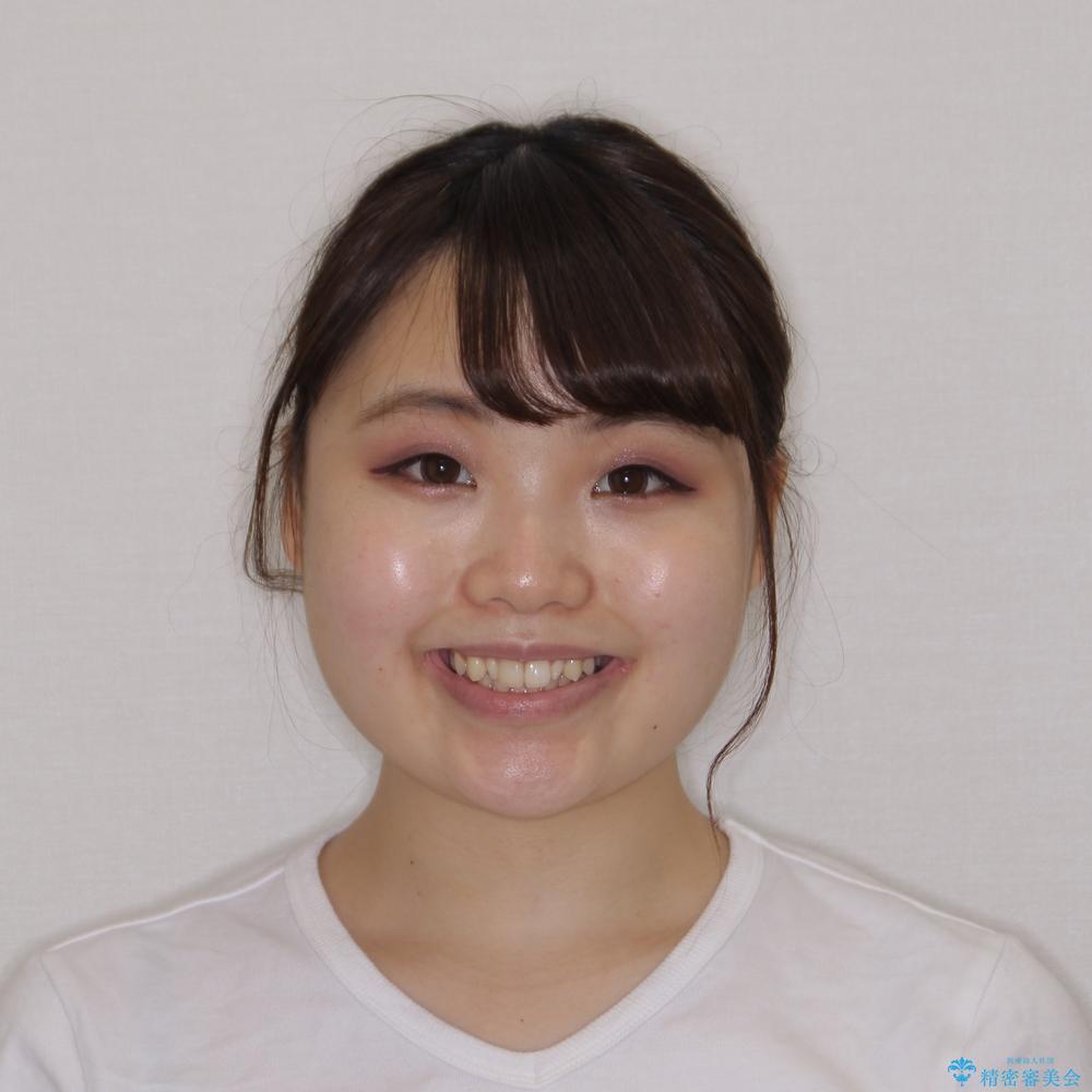 【モニター】ワイヤー矯正で手っ取り早く治療の治療前(顔貌)