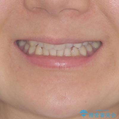 捻れた前歯と銀歯のブリッジを治したい ワイヤー矯正とオールセラミックブリッジの治療前(顔貌)