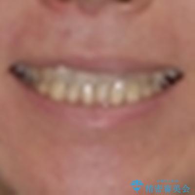 リスク回避 ワイヤー矯正を併用したインビザライン矯正治療の治療前(顔貌)