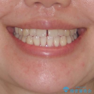 すきっ歯とオープンバイトをインビザラインで改善の治療前（顔貌）
