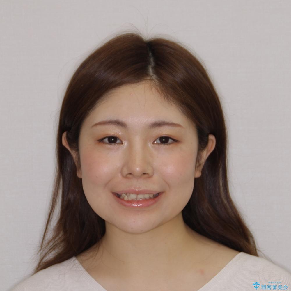 【モニター】前歯の歯列不正をワイヤー装置で短期間矯正治療の治療前(顔貌)