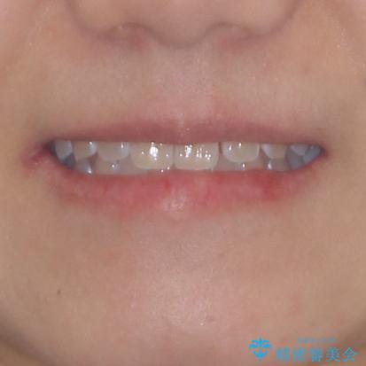 前歯の隙間と上下正中のズレを解消の治療前（顔貌）