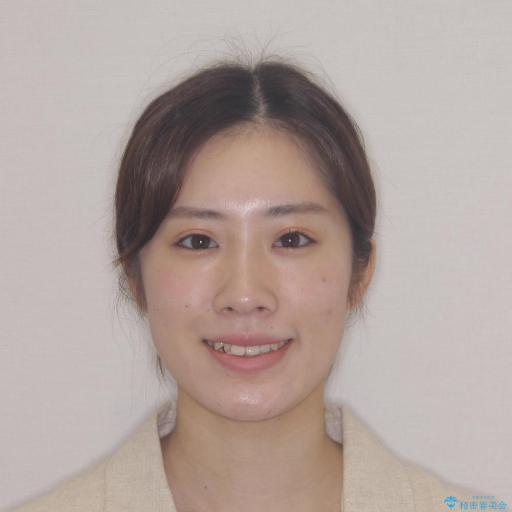 【モニター】前歯の前突感とクロスバイトをインビザラインで改善の治療前(顔貌)