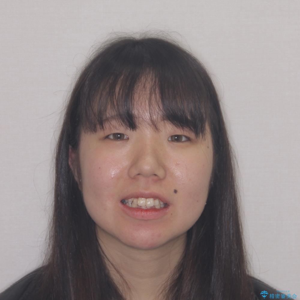 【モニター】八重歯を抜歯矯正でスッキリした口元にの治療前(顔貌)