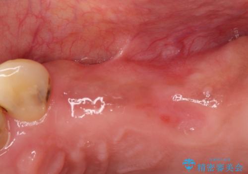【インプラント】奥歯に歯を入れたいの治療前