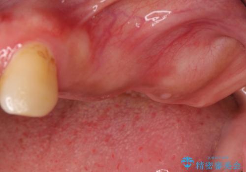 【インプラント】奥歯に歯を入れたいの治療前