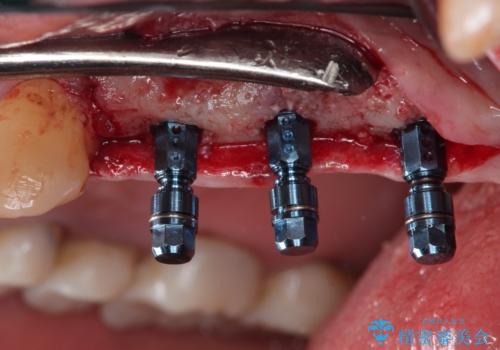 【インプラント】奥歯に歯を入れたいの治療中