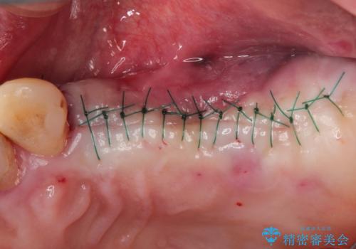 【インプラント】奥歯に歯を入れたいの治療中