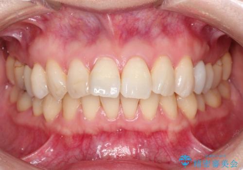 【インビザライン 】前歯を下げたいの治療前