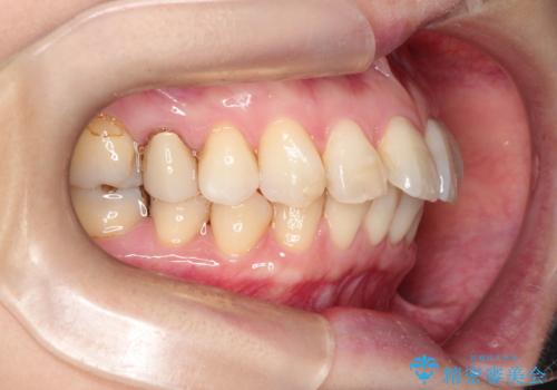 【インビザライン 】前歯を下げたいの治療前