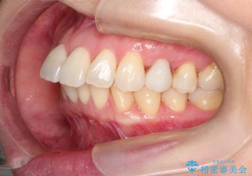 【インビザライン 】前歯を下げたいの治療前