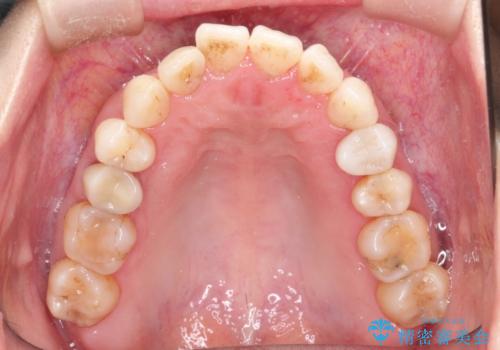 【インビザライン 】前歯を下げたいの治療前