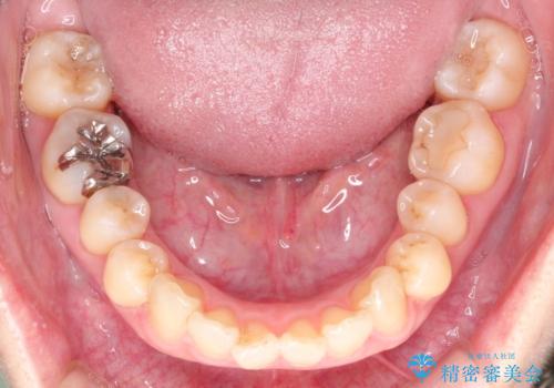 【インビザライン 】前歯を下げたいの治療前