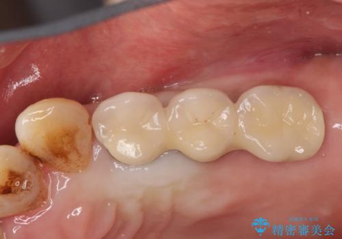 【インプラント】奥歯に歯を入れたいの治療後