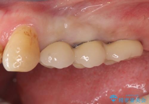 【インプラント】奥歯に歯を入れたいの治療後
