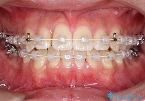 【ワイヤー矯正】前歯の凸凹を治したい。の治療中