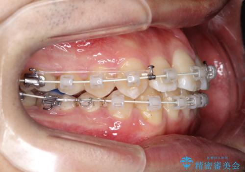 【ワイヤー矯正】前歯の凸凹を治したい。の治療中