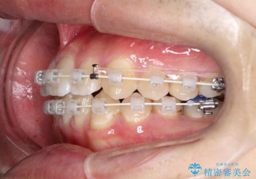 【ワイヤー矯正】前歯の凸凹を治したい。の治療中
