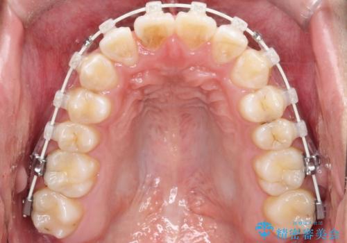【ワイヤー矯正】前歯の凸凹を治したい。の治療中