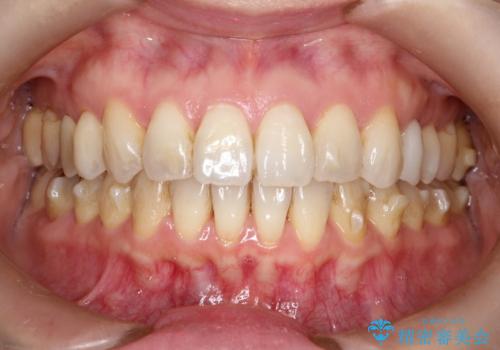 【インビザライン 】前歯を下げたいの治療中