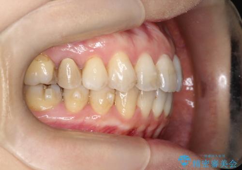 【インビザライン 】前歯を下げたいの治療中