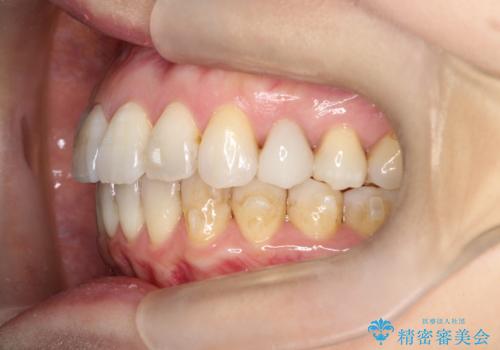 【インビザライン 】前歯を下げたいの治療中