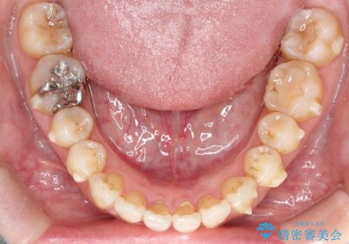 【インビザライン 】前歯を下げたいの治療中