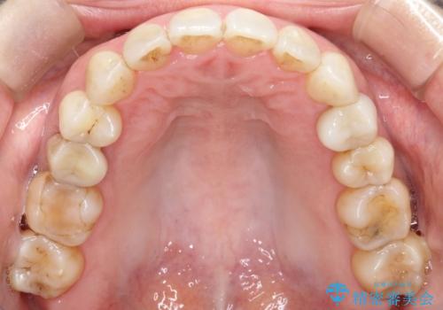 【インビザライン 】前歯を下げたいの治療中