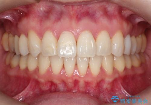 【インビザライン 】前歯を下げたいの治療後