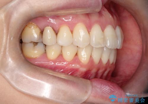 【インビザライン 】前歯を下げたいの治療後
