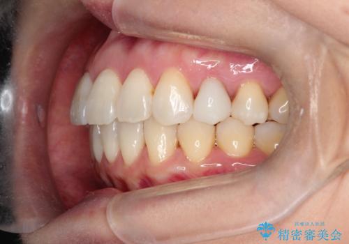 【インビザライン 】前歯を下げたいの治療後