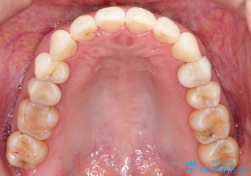 【インビザライン 】前歯を下げたいの治療後