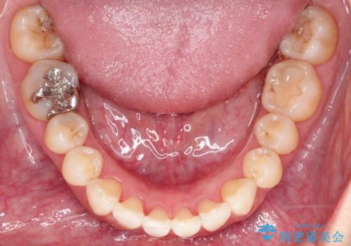 【インビザライン 】前歯を下げたいの治療後