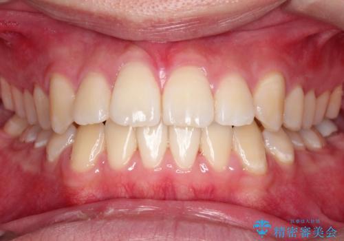 【ワイヤー矯正】前歯の凸凹を治したい。の症例 治療後