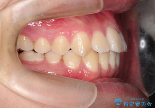 【ワイヤー矯正】前歯の凸凹を治したい。の治療後