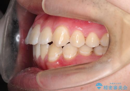 【ワイヤー矯正】前歯の凸凹を治したい。の治療後