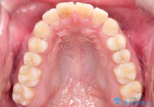 【ワイヤー矯正】前歯の凸凹を治したい。の治療後